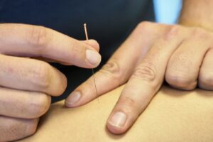 Dry Needling, fysiotherapie Wennekers